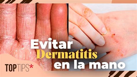 dermatitis hongos en las manos